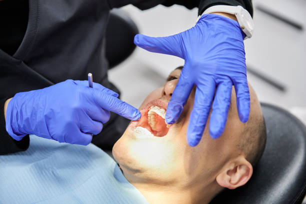 Best Emergency Wisdom Tooth Extraction in Boyce, LA